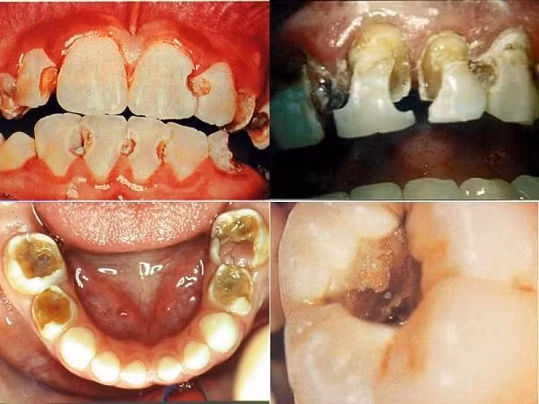 Sâu răng (Ảnh minh họa/ Nguồn: Internet)