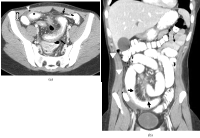 Tất nhiên điều này cũng phụ thuộc vào từng cá nhân, tôi đã nhìn thấy nhiều người bệnh ăn uống không kiêng khem gì cả nhưng vẫn không có vấn đề gì xảy ra. Nhưng nhìn chung, chế độ ăn ít chất xơ vẫn an toàn hơn cho tới khi tình trạng bệnh chuyển biến tốt hơn. Xem thêm:7 loại thực phẩm giúp bạn trẻ lâu hơn