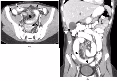 Tất nhiên điều này cũng phụ thuộc vào từng cá nhân, tôi đã nhìn thấy nhiều người bệnh ăn uống không kiêng khem gì cả nhưng vẫn không có vấn đề gì xảy ra. Nhưng nhìn chung, chế độ ăn ít chất xơ vẫn an toàn hơn cho tới khi tình trạng bệnh chuyển biến tốt hơn. Xem thêm:7 loại thực phẩm giúp bạn trẻ lâu hơn
