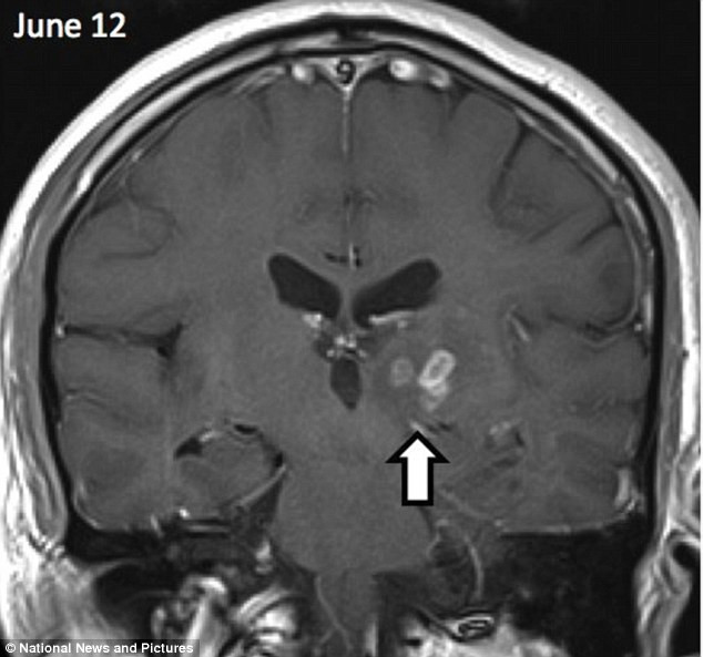 Con sán dài 5cm di chuyển từ bán cầu não phải sang bán cầu não trái của người đàn ông (Ảnh: Dailymail) Con sán dài 5cm di chuyển từ bán cầu não phải sang bán cầu não trái của người đàn ông (Ảnh: Dailymail)