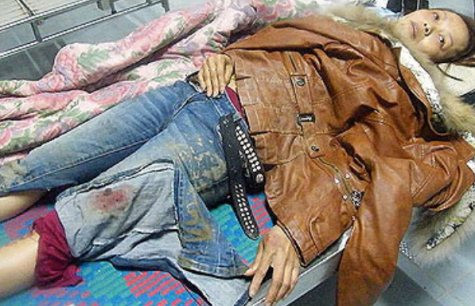 Chị Thủy nằm điều trị tại phòng cấp cứu Bệnh viện Đa khoa huyện Hương Sơn sau vu đánh ghen kinh hoàn.