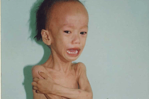 Thật thương tâm vì trẻ em thiếu dinh dưỡng vẫn còn rất nhiều trên thế giới. Các tổ chức y tế thế giới cũng đã và đang nỗ lực tìm ra những giải pháp thích hợp với từng quốc gia để cứu trợ và hướng dẫn người dân cách chăm sóc trẻ suy dinh dưỡng. Thật thương tâm vì trẻ em thiếu dinh dưỡng vẫn còn rất nhiều trên thế giới. Các tổ chức y tế thế giới cũng đã và đang nỗ lực tìm ra những giải pháp thích hợp với từng quốc gia để cứu trợ và hướng dẫn người dân cách chăm sóc trẻ suy dinh dưỡng.