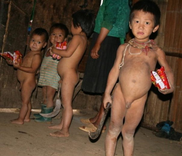 Suy dinh dưỡng, điều kiện sống quá thấp dẫn đến trẻ xanh xao, nhợt nhạt, bụng ỏng đít beo, giun sán,... Suy dinh dưỡng, điều kiện sống quá thấp dẫn đến trẻ xanh xao, nhợt nhạt, bụng ỏng đít beo, giun sán,...