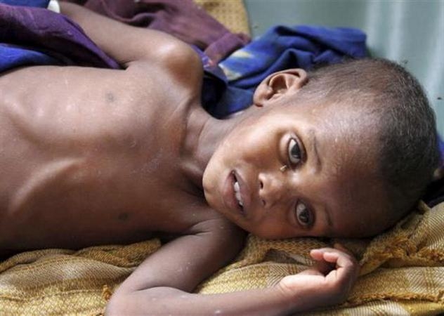 Trẻ suy dinh dưỡng sẽ lờ đờ, phản xạ chậm, đầu to, mắt lồi....Những hình ảnh này luôn nhắc nhở chúng ta về chế độ dinh dưỡng hợp lí để trẻ có thể phát triển bình thường được. Trẻ suy dinh dưỡng sẽ lờ đờ, phản xạ chậm, đầu to, mắt lồi....Những hình ảnh này luôn nhắc nhở chúng ta về chế độ dinh dưỡng hợp lí để trẻ có thể phát triển bình thường được.