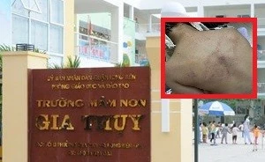 Phụ huynh tố con bị bạo hành tím lưng, Trường Mầm non Gia Thụy tạm đình chỉ giáo viên