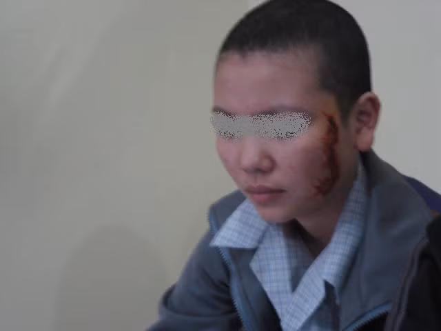 Vết sẹo lõm sâu trên mặt G Vết sẹo lõm sâu trên mặt G