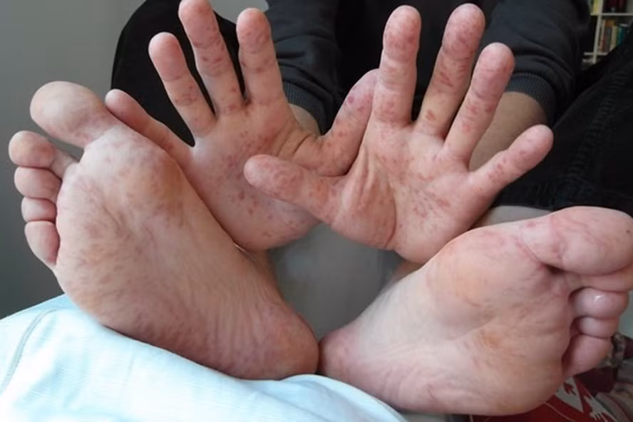 Các bác sĩ khuyến cáo, hiện chưa có thuốc đặc trị bệnh tay chân miệng, bởi vậy để phòng tránh cha mẹ tăng cường vệ sinh, đặc biệt là rửa tay thường xuyên, dùng dụng cụ, bát đĩa riêng, huấn luyện cho các bé không mút tay, ngậm đồ chơi và vệ sinh đúng chỗ. Các bác sĩ khuyến cáo, hiện chưa có thuốc đặc trị bệnh tay chân miệng, bởi vậy để phòng tránh cha mẹ tăng cường vệ sinh, đặc biệt là rửa tay thường xuyên, dùng dụng cụ, bát đĩa riêng, huấn luyện cho các bé không mút tay, ngậm đồ chơi và vệ sinh đúng chỗ.