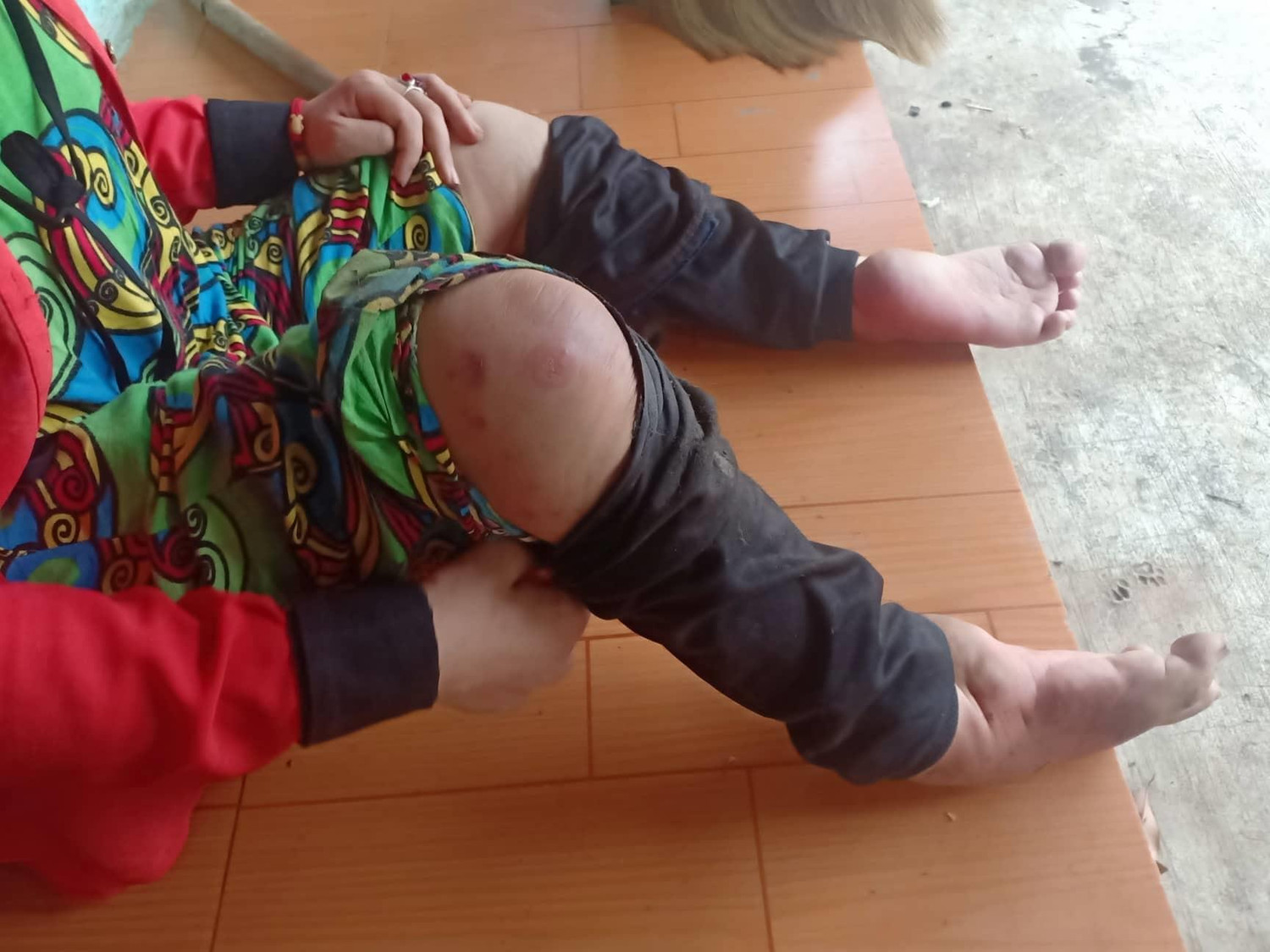 Đôi chân tàn tật, dạo này nhiều nốt đỏ mọc lên đau nhói nhưng chị Đặng Thị Yến hàng ngày vẫn làm lụng chăm sóc, nuôi mẹ bệnh tật. Chị ước có một chiếc xe điện ba bánh để đi lại dễ dàng hơn (ảnh Kim Sơn).