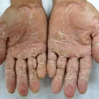 Theo các chuyên gia phòng chống độc của Việt Nam, để tìm ra nguyên nhân thì việc cần làm bây giờ là tìm hiểu tiền sử, quá trình tiếp xúc của người bệnh, còn việc tìm các hóa chất gây độc là rất khó. Xem thêm: Phát hoảng với những thân hình "khủng" nhất thế giới do ăn nhiều / 11 loại thảo dược dễ tìm giúp bạn có hơi thở thơm tho Theo các chuyên gia phòng chống độc của Việt Nam, để tìm ra nguyên nhân thì việc cần làm bây giờ là tìm hiểu tiền sử, quá trình tiếp xúc của người bệnh, còn việc tìm các hóa chất gây độc là rất khó. Xem thêm: Phát hoảng với những thân hình "khủng" nhất thế giới do ăn nhiều / 11 loại thảo dược dễ tìm giúp bạn có hơi thở thơm tho