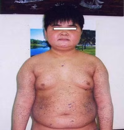 Rối loạn chuyển hóa sắc tố và béo phì do corticoid. Xem thêm: Những cặp sinh đôi dính liền kỳ lạ nhất thế giới. Rối loạn chuyển hóa sắc tố và béo phì do corticoid. Xem thêm: Những cặp sinh đôi dính liền kỳ lạ nhất thế giới.