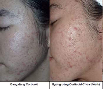 Ngoài ra, corticoid chống chỉ định với bệnh nhân nhiễm nấm toàn thân và quá mẫn cảm với thuốc. Đặc biệt chú ý sử dụng thận trọng khi thật cần thiết đối với phụ nữ mang thai và cho con bú vì thuốc có thể truyền qua nhau thai và bài tiết qua sữa. Xem thêm: Những cặp sinh đôi dính liền kỳ lạ nhất thế giới. Ngoài ra, corticoid chống chỉ định với bệnh nhân nhiễm nấm toàn thân và quá mẫn cảm với thuốc. Đặc biệt chú ý sử dụng thận trọng khi thật cần thiết đối với phụ nữ mang thai và cho con bú vì thuốc có thể truyền qua nhau thai và bài tiết qua sữa. Xem thêm: Những cặp sinh đôi dính liền kỳ lạ nhất thế giới.