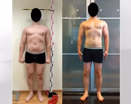 Kéo dài cơ thể thêm hơn 15cm: Một người đàn ông ở New York đã chấp nhận đau đớn để có thể cao thêm 15,24cm thông qua hàng loạt các ca phẫu thuật tăng chiều cao. Bác sĩ phẫu thuật chỉnh hình nổi tiếng – tiến sĩ Dror Paley tuyên bố rằng phần lớn các bệnh nhân đến với trung tâm y tế St. Mary đều có chung 1 lý do. Akash Shukla là một trong những bệnh nhân được Paley thực hiện trực tiếp. Ở tuổi 18, người đàn ông cao 1,5m này đã quyết định tiến hành ca phẫu thuật. Sau khi hoàn thành anh đã cao lên trông thấy so với trước đây. Theo tiết lộ, quá trình này tốn kém khoảng 85.000 đô la Mỹ. Kéo dài cơ thể thêm hơn 15cm: Một người đàn ông ở New York đã chấp nhận đau đớn để có thể cao thêm 15,24cm thông qua hàng loạt các ca phẫu thuật tăng chiều cao. Bác sĩ phẫu thuật chỉnh hình nổi tiếng – tiến sĩ Dror Paley tuyên bố rằng phần lớn các bệnh nhân đến với trung tâm y tế St. Mary đều có chung 1 lý do. Akash Shukla là một trong những bệnh nhân được Paley thực hiện trực tiếp. Ở tuổi 18, người đàn ông cao 1,5m này đã quyết định tiến hành ca phẫu thuật. Sau khi hoàn thành anh đã cao lên trông thấy so với trước đây. Theo tiết lộ, quá trình này tốn kém khoảng 85.000 đô la Mỹ.