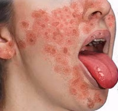 Thiếu vitamin B3 gây viêm da tróc vảy.