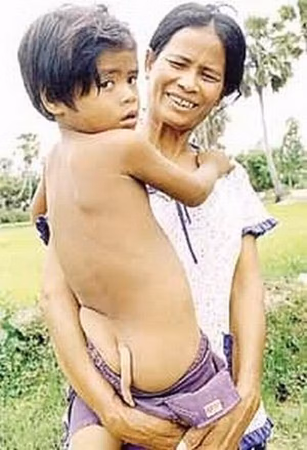 Cậu bé Chhorn Tola, sống ở làng Chheu Kach, Campuchia khi sinh ra cũng đã có 1 bộ phận thừa trông như 1 cái đuôi. Cậu bé Chhorn Tola, sống ở làng Chheu Kach, Campuchia khi sinh ra cũng đã có 1 bộ phận thừa trông như 1 cái đuôi.