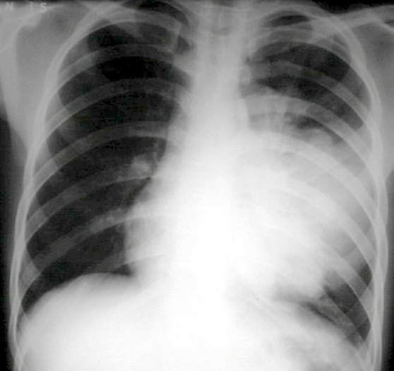9. Viêm phổi: Ho và giảm cân có thể là chỉ báo về một bệnh nhiễm trùng nghiêm trọng do vi khuẩn gây ra, mà bình thường nếu hệ miễn dịch khỏe mạnh bạn không thể mắc.