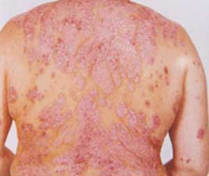 12. Bệnh nấm: Một loại bệnh nấm khác người có HIV hay gặp ở giai đoạn muộn là bệnh tưa miệng - do nấm Candida gây ra, thường gây khó nuốt.