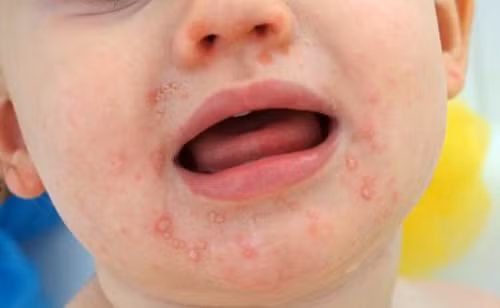Bệnh tay chân miệng hiện chưa có vắc xin điều trị, nếu trẻ nhỏ bị mắc mà không điều trị kịp thời sẽ gây ra nhiều biến chứng nguy hiểm. Ảnh minh họa, nguồn: Internet.