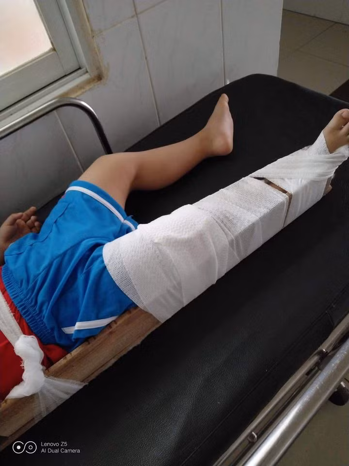 Con trai của chị C. bị gãy chân sau một tai nạn trong giờ học ở trường (ảnh: CTV) Con trai của chị C. bị gãy chân sau một tai nạn trong giờ học ở trường (ảnh: CTV)