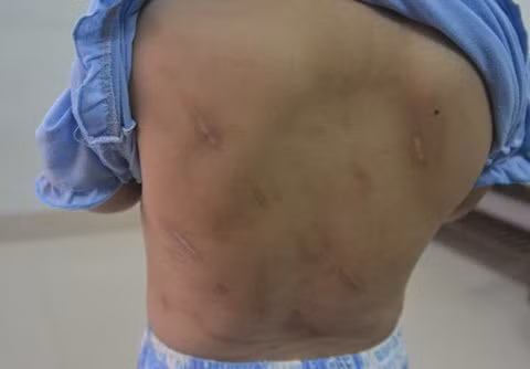 Có nhiều vết thương sưng tấy, bầm tím do bị đánh đập.