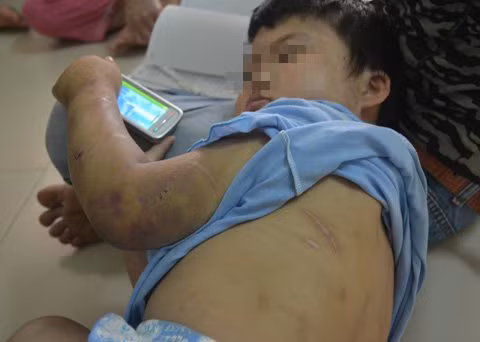 Nhiều người dân sống trong khu vực cho biết, hơn một năm nay, anh Hùng thường xuyên bạo hành, đánh đập dã man con gái