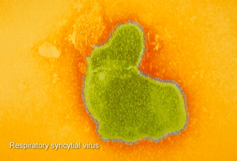 1.Bệnh RSV: Đây là từ viết tắt của virus tế bào hô hấp, loại virus này cũng chính là nguyên nhân hàng đầu gây nên các bệnh về viêm tiểu phế quản (viêm đường hô hấp nhỏ) và viêm phổi ở trẻ sơ sinh. Triệu chứng của căn bệnh này giống như cúm, bao gồm sốt, chảy nước mũi, và ho. Tuy nhiên, căn bệnh này sẽ giảm dần theo sự phát triển của cơ thể.