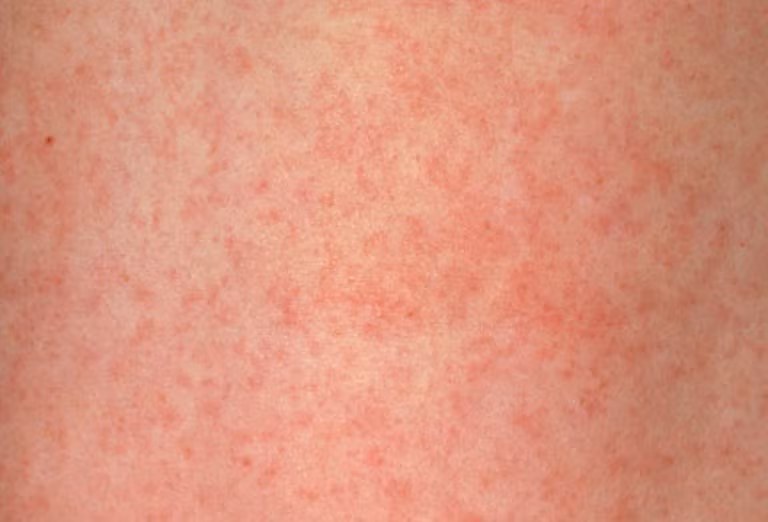 13. Rubella (sởi Đức): Rubella, hay còn gọi là sởi Đức, bệnh do một loài virus gây ra, nhưng không gây vấn đề nghiêm trọng đến sức khỏe. Các triệu chứng thường gặp là sốt nhẹ và phát ban lây lan từ mặt đến các bộ phận khác của cơ thể.