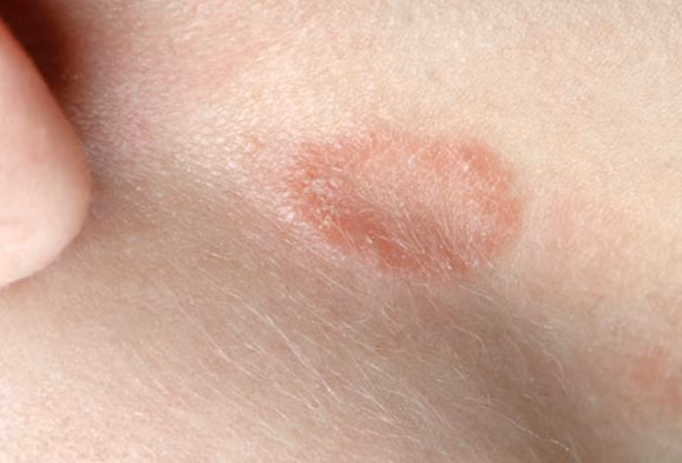 21. Nấm da: Đây là căn bệnh rất dễ lây lan, nhất là khi trẻ đi đến trường và phải dùng chung đồ.