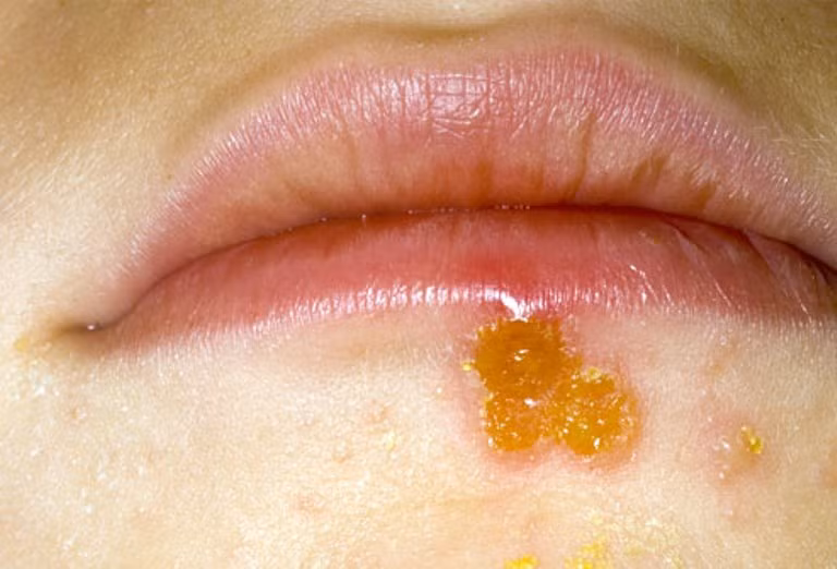 20. Chốc lở da: Chốc lở là một bệnh nhiễm trùng da do vi khuẩn gây nên. Đây là loại bệnh phổ biến nhất ở trẻ em độ tuổi từ 2 đến 6. Bệnh được điều trị bằng kháng sinh.
