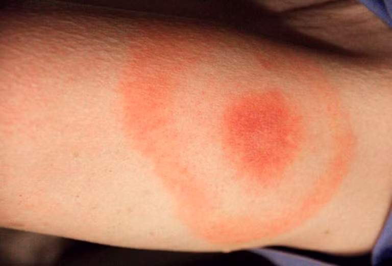 22. Bệnh Lyme: Thủ phạm gây bệnh là một loại vi khuẩn giống như bọ ve hươu nhỏ. Nếu không được điều trị, bệnh có thể ảnh hưởng đến các khớp xương, hệ thần kinh và tim.