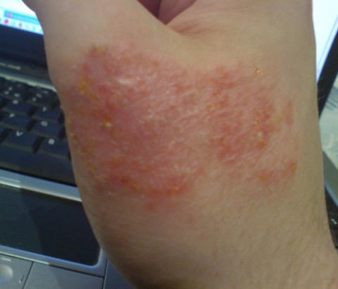 Chàm bội nhiễm (Eczema): Eczema còn gọi là chứng viêm da atopic làm người bệnh rất ngứa và đau đớn, các nốt phát ban có vảy thường mọc gần mặt, khuỷu tay và đầu gối. Tình trạng có thể trở nên tồi tệ hơn do mồ hôi, quần áo hoặc thời tiết khô và rất khó chữa. Eczema là triệu chứng thường gặp khi bị dị ứng với sữa, trứng, cá và bột mỳ. Xem thêm:Điểm danh 12 loại rau, quả dễ nhiễm thuốc trừ sâu hàng đầu 2012