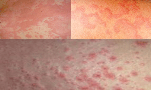 Nổi mề đay cấp tính là phản ứng dị ứng trên toàn cơ thể, gây khó thở do bị sưng nề đường thở và huyết áp giảm đột ngột do thành mạch máu bị giãn. Nổi mề đay cấp tính thường nặng lên rất nhanh khi tiếp xúc với tác nhân gây dị ứng, do đó sẽ dễ dàng tìm ra nguyên nhân dị ứng. Xem thêm:Điểm danh 12 loại rau, quả dễ nhiễm thuốc trừ sâu hàng đầu 2012