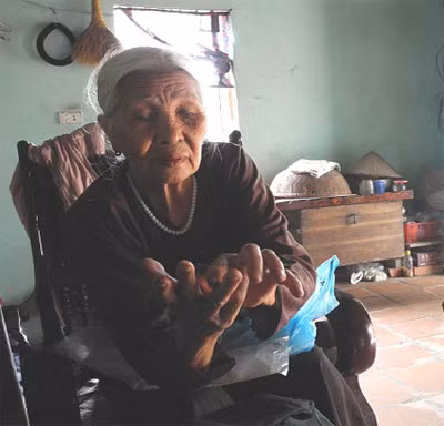 Bà Gái chỉ cho phóng viên vết tích những lần bị chính con trai mình bạo hành.