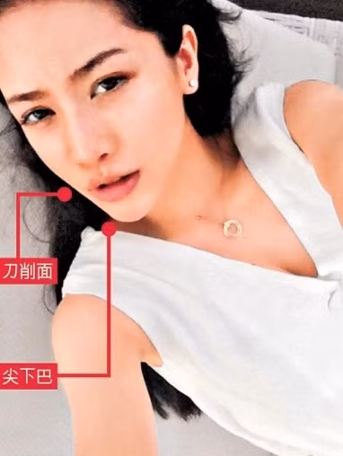 Xương quai hàm, cằm dưới sau phẫu thuật trở nên tinh tế và sắc nét.
