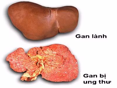 Chuyện gì xảy ra nếu bạn mắc Viêm gan C? ảnh 8