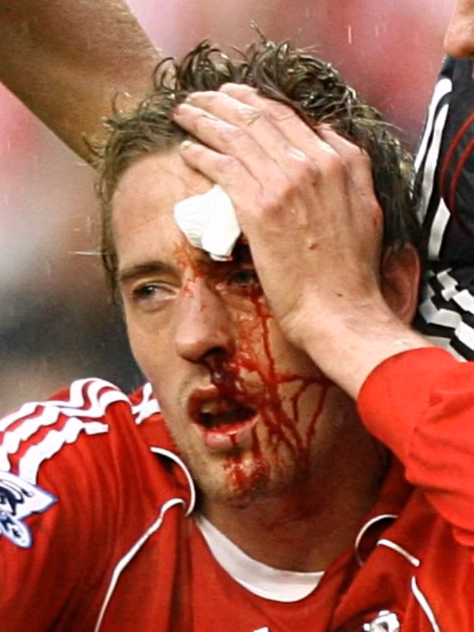 Khuân mặt đầy máu của tiền đạo Peter Crouch khi còn khoác áo Liverpool.