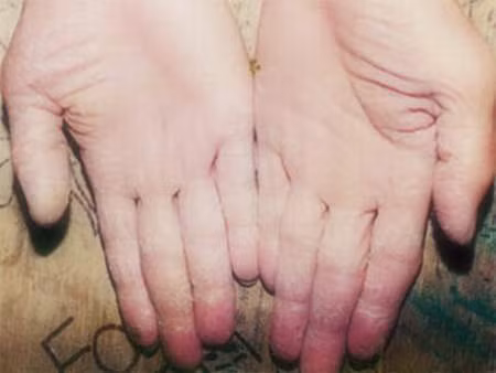 Người bị á sừng tuyệt đối nhớ hoàn toàn không tiếp xúc với hóa chất tẩy rửa.