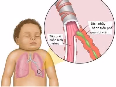 Trẻ bị viêm phế quản cấp vẫn phải bú mẹ, nếu trẻ không tự bú được thì phải vắt sữa ra bình, cốc hoặc cho trẻ ăn sữa ngoài nếu mẹ không có sữa. Để bảo đảm chế độ dinh dưỡng, các bà mẹ vẫn duy trì chế độ ăn có nhiều vitamin, muối khoáng, ăn nhiều hoa quả, ăn tăng cường nếu trẻ trong thời kỳ ăn dặm, cho trẻ nằm nơi thoáng mát...(Ảnh: ITN) Xem thêm: Chùm ảnh: Sự nguy hiểm của việc sâu răng ở trẻ