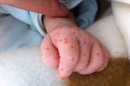 Mụn nhọt: Vào mùa hè nếu không giữ gìn vệ sinh da tốt, trẻ rất dễ bị mụn nhọt. Mụn nhọt ở mức độ nhẹ có thể tự khỏi và không ảnh hưởng tới cơ thể, không gây nguy hiểm, nếu bị nặng hơn, mụn nhọt có thể gây ra hiện tượng đau nhức, sốt, trẻ biếng ăn, hay bứt rứt, phải đưa trẻ đi khám bác sĩ khám, có thể chích mụn để thoát lưu mủ.(Ảnh: ITN) Xem thêm: Chùm ảnh: Sự nguy hiểm của việc sâu răng ở trẻ
