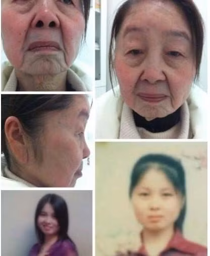 Hình ảnh phụ nữ trước và sau khi phẫu thuật thẫm mỹ.