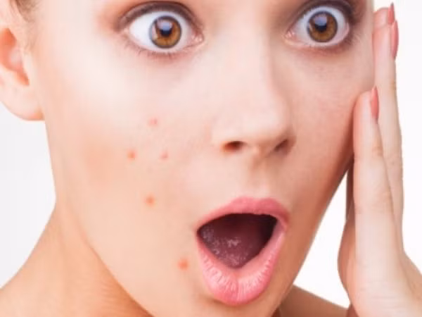 Làm thế nào để sử dụng dầu mè trong điều trị mụn trứng cá? ảnh 2