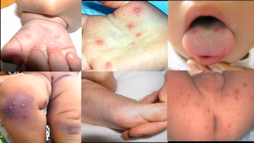 Trẻ em và thiếu niên là những đối tượng dễ bị nhiễm bệnh và biểu hiện bệnh nhất vì cơ thể chưa có kháng thể chống lại bệnh này. Trẻ em và thiếu niên là những đối tượng dễ bị nhiễm bệnh và biểu hiện bệnh nhất vì cơ thể chưa có kháng thể chống lại bệnh này.