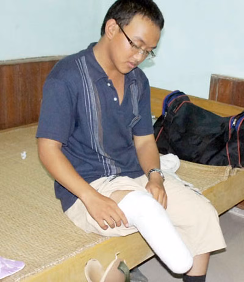 Thí sinh Lê Hà Tiền quê ở xã Quỳnh Lập, Quỳnh Lưu,Nghệ An dự thi vào ĐH Vinh. Trong ảnh Hiền đang quấn vải vào khúc chân phải để ráp chân giả vào đến phòng thi cho bớt đau.