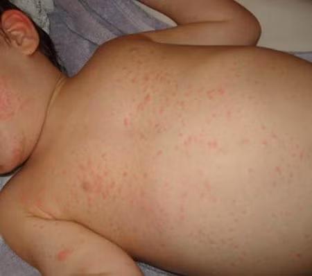 Làm cách để khỏi phát ban nhanh nhất? ảnh 2