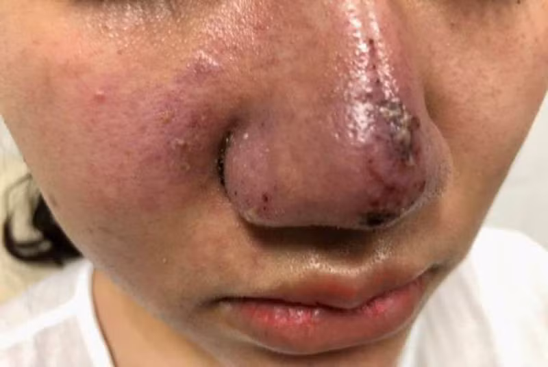 Một trường hợp bị biến chứng do tiêm chất làm đầy. Một trường hợp bị biến chứng do tiêm chất làm đầy.