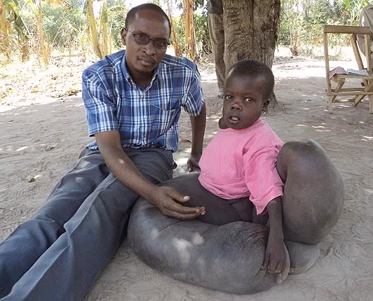 Cũng có người cho rằng cậu Một số bác sĩ Uganda cho rằng Vincent mắc chứng bệnh chân voi (elephantitis) và biến dạng mô. Cũng có người cho rằng cậu Một số bác sĩ Uganda cho rằng Vincent mắc chứng bệnh chân voi (elephantitis) và biến dạng mô.