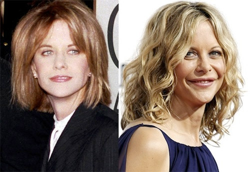 Meg Ryan trước và sau khi sử dụng botox.