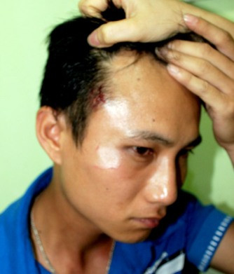 Vết thương trên đầu anh Nam.